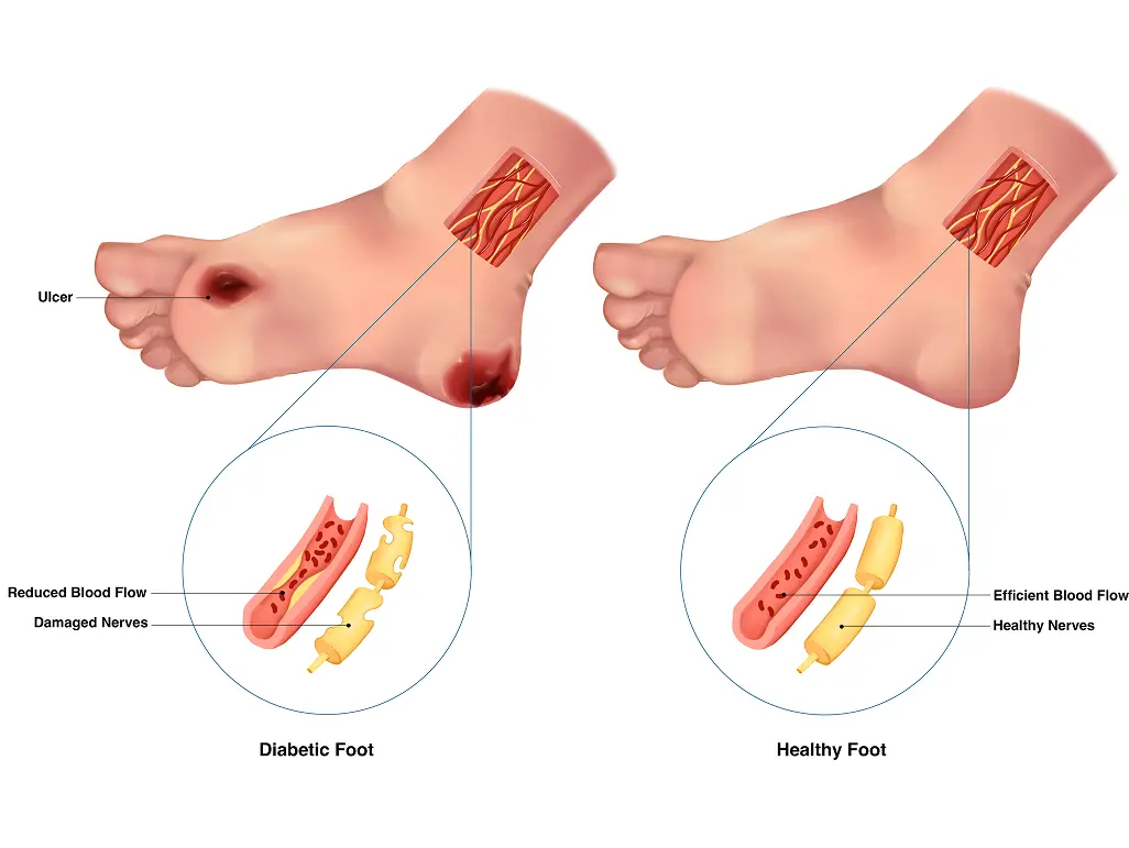 Diabetes Complications — Composition & Rendering