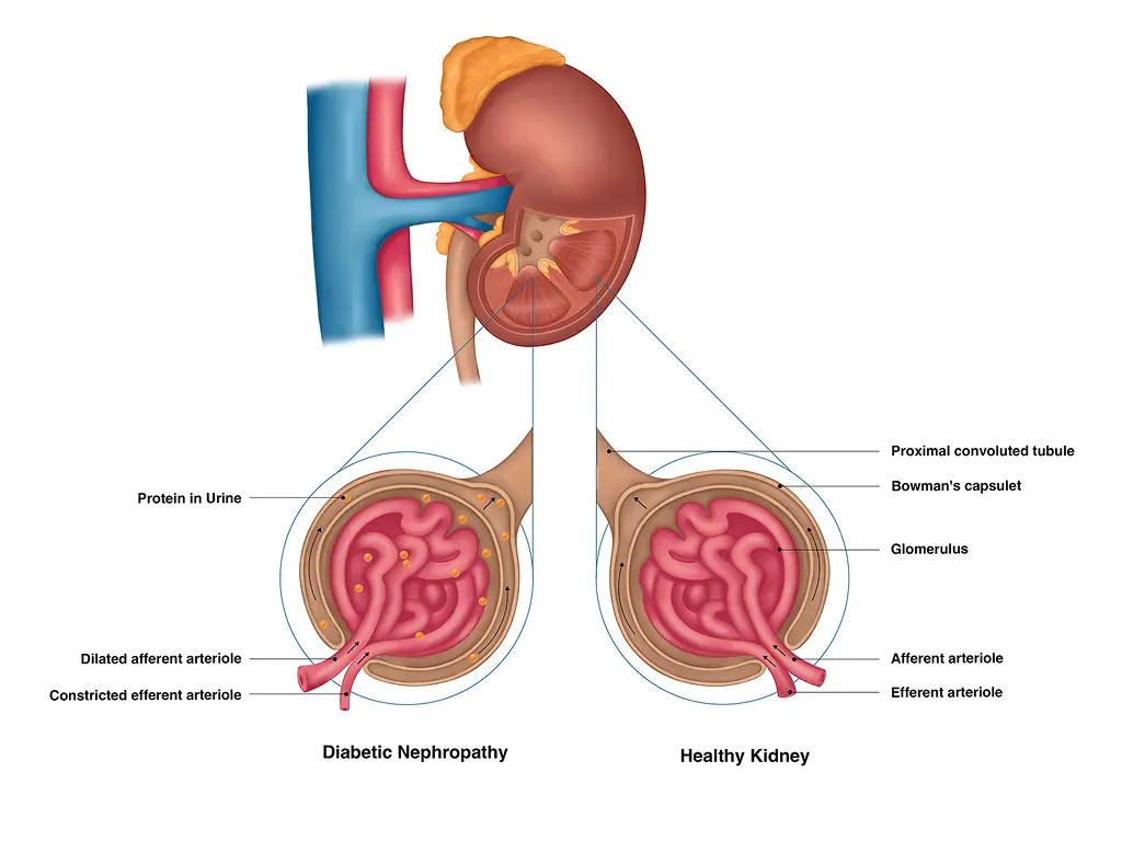 Diabetes Complications — Composition & Rendering