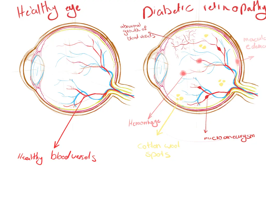 Diabetes Complications — Research & Ideation