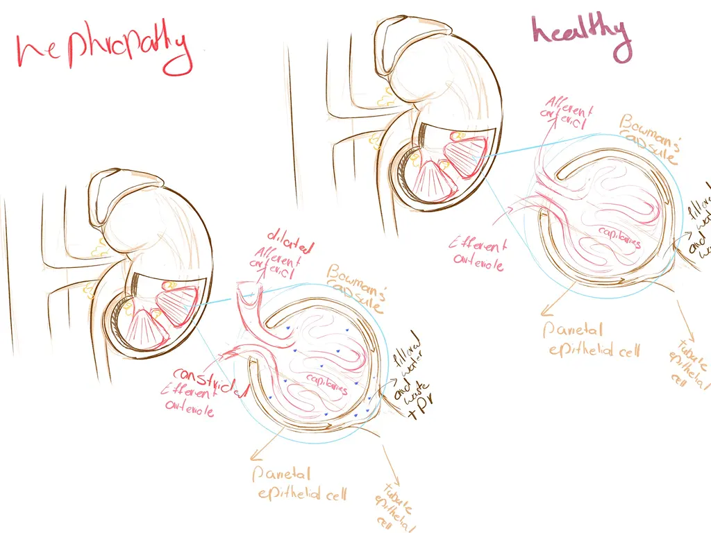 Diabetes Complications — Research & Ideation